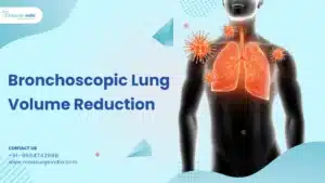 Bronchoscopic Lung Volume Reduction