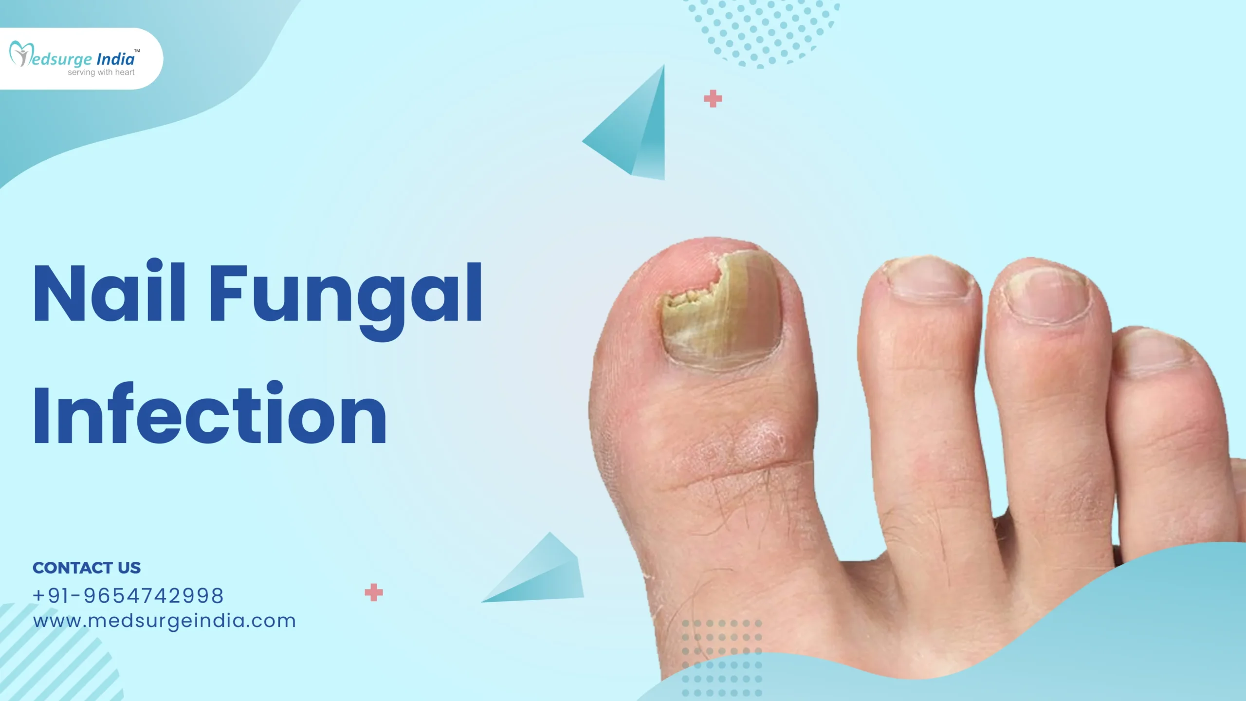 Nail Fungal Infection