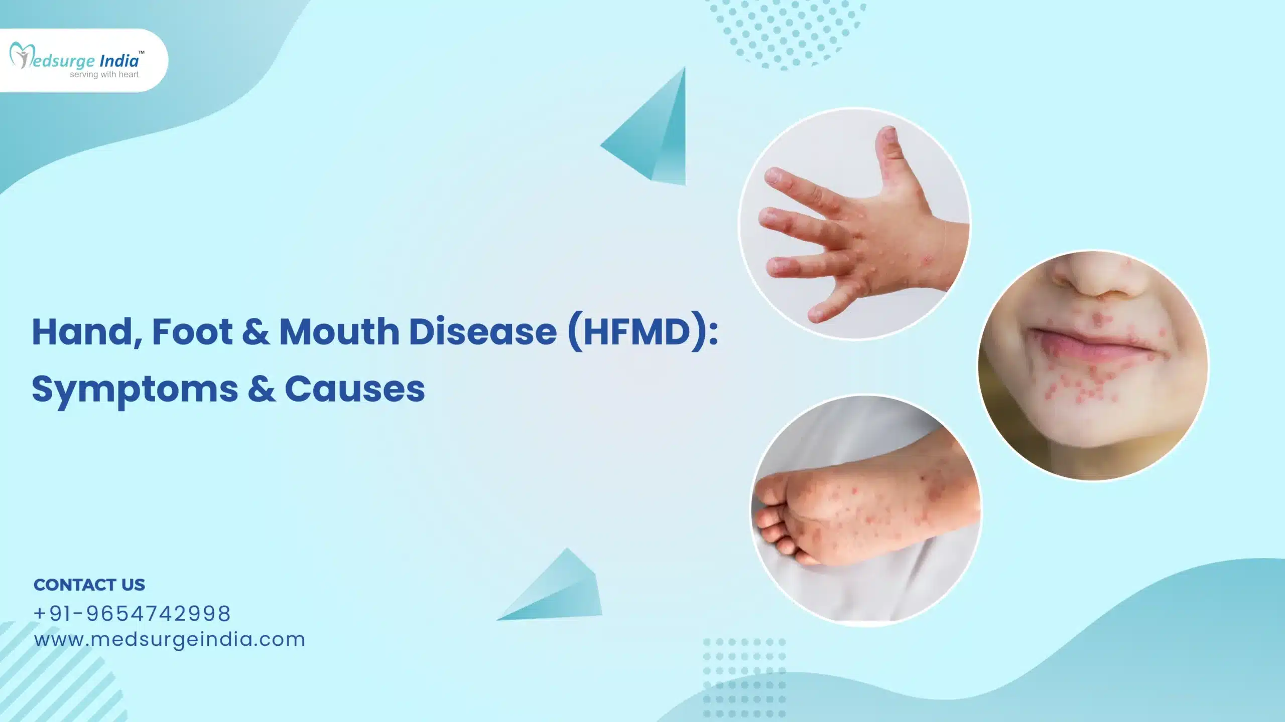 Hand-Foot & Mouth Disease (HFMD): Symptoms & Causes