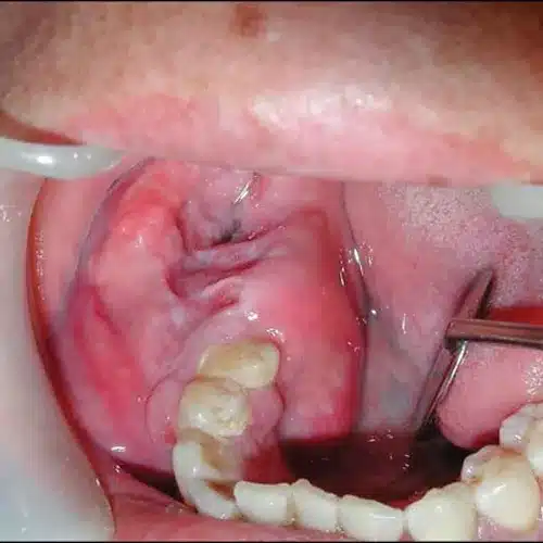 Ameloblastoma Treatment 