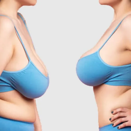 Breast Reduction Surgery 
