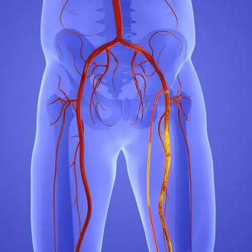 Femoro Femoral Bypass 
