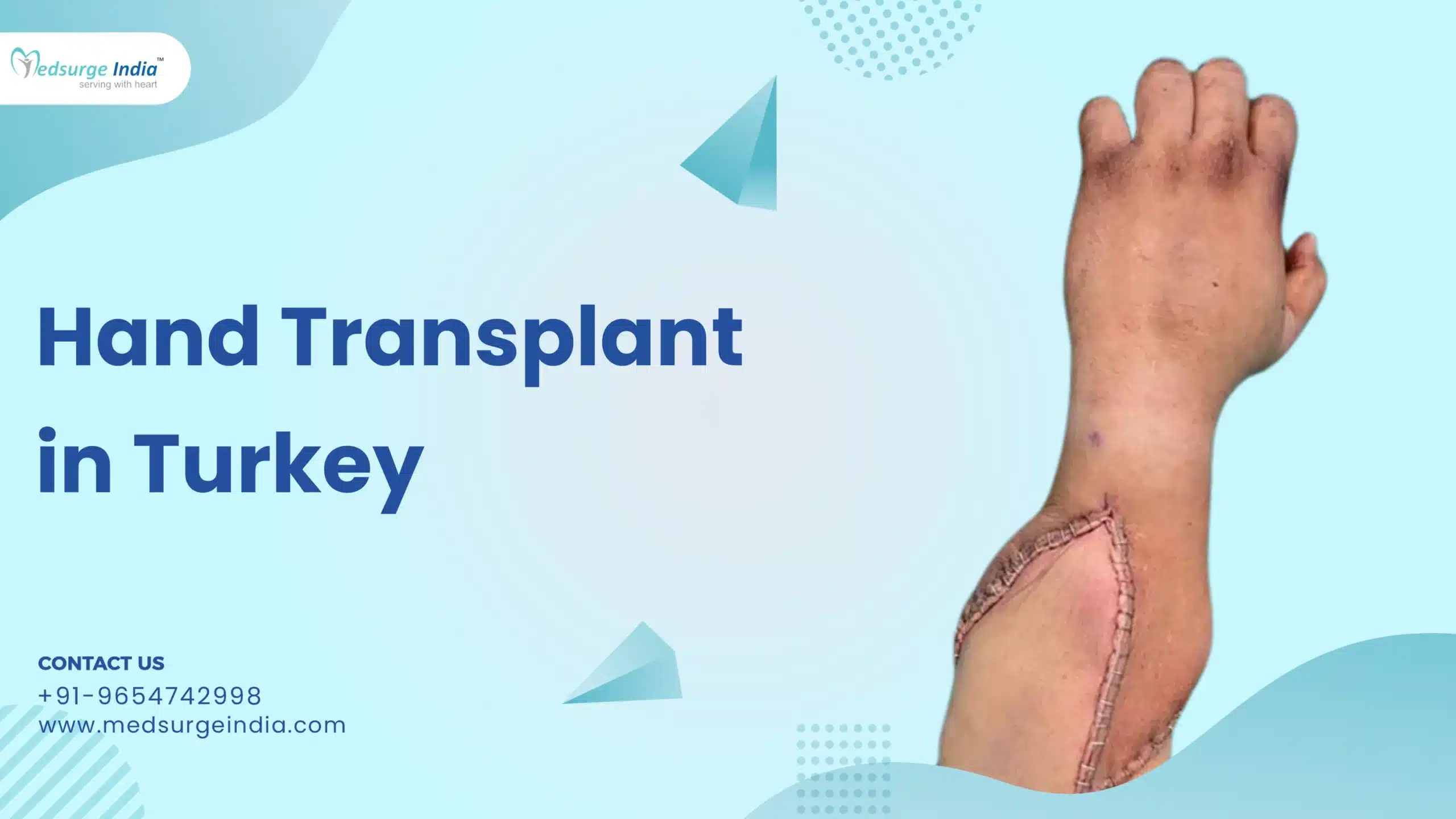 Hand Transplant Cost in Turkey