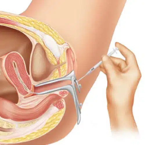 Intrauterine Insemination IUI Treatment 