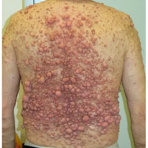 Neurofibromatosis Treatment 