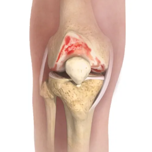 Osteoarthritis Surgery 