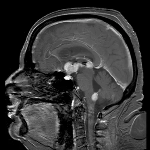 Primary CNS Lymphoma Treatment 