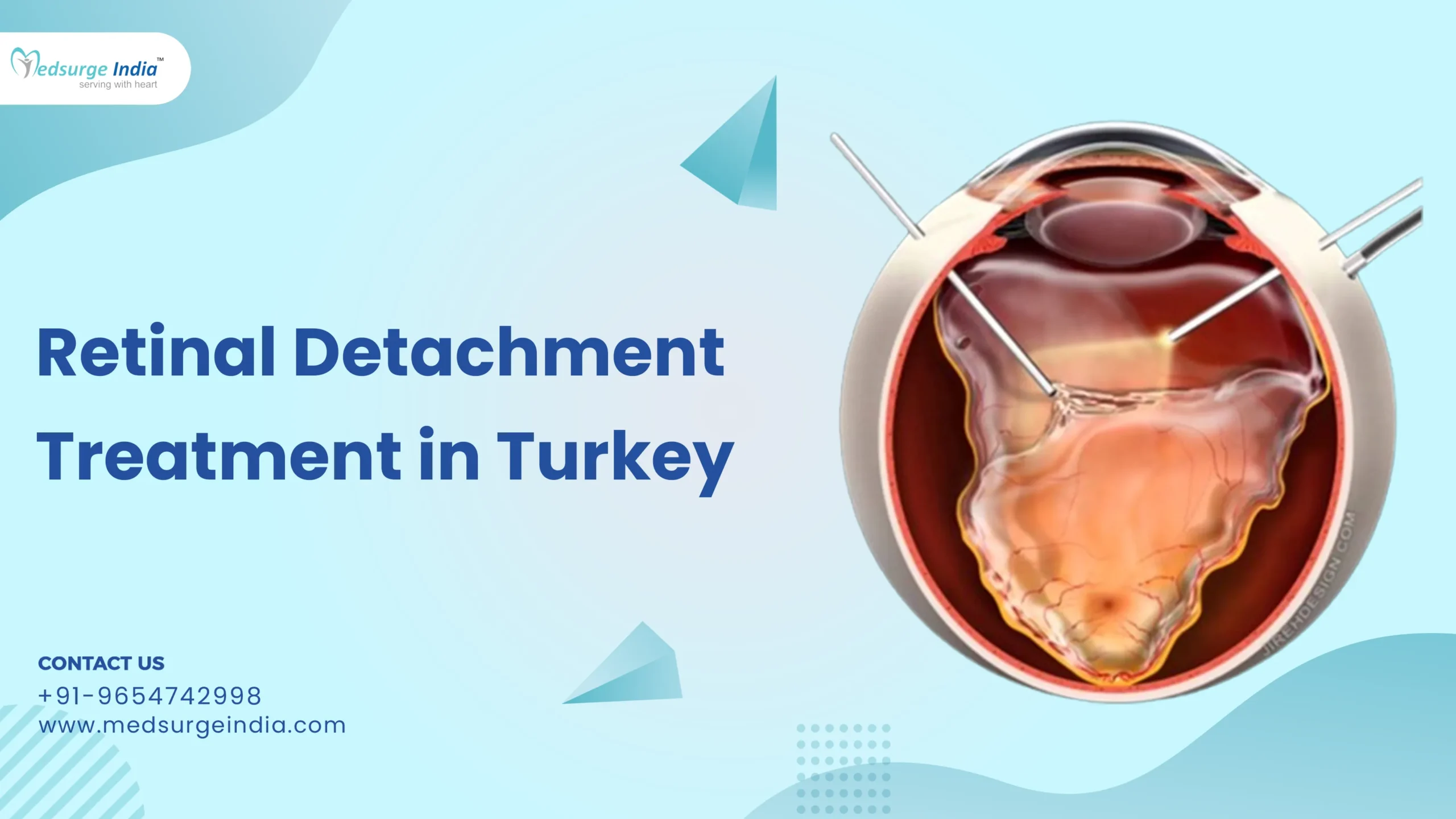 Retinal Detachment Treatment Cost in Turkey