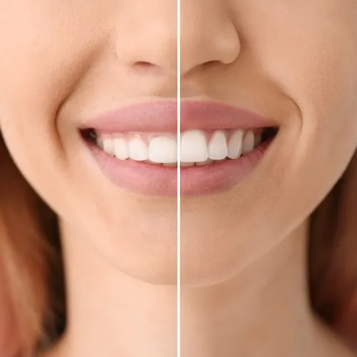 Tooth Reshaping and Dental Contouring 