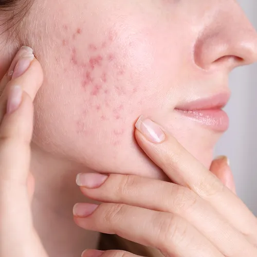 Acne Scar Treatment