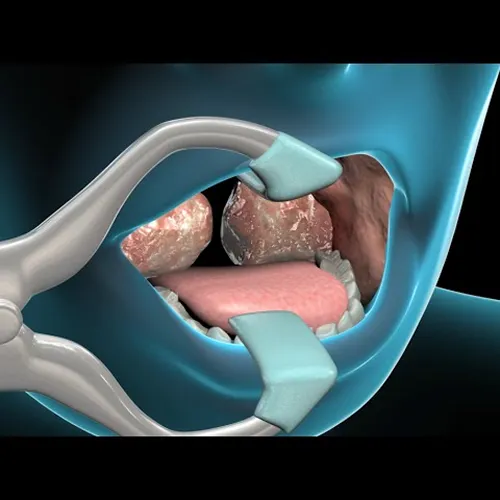 Adenoidectomy Surgery