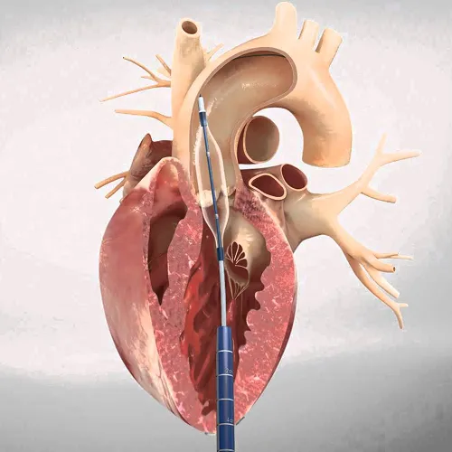 Aortic Valve Replacement