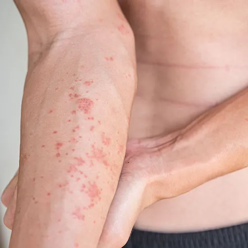 Atopic Dermatitis Treatment