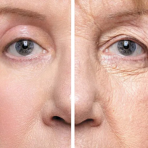 Blepharoplasty Eye Lid Surgery