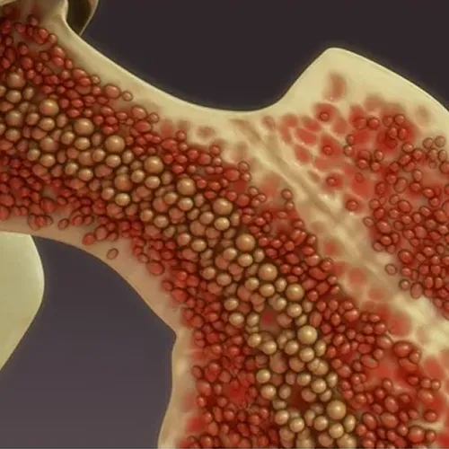 Bone Marrow Transplant In Delhi