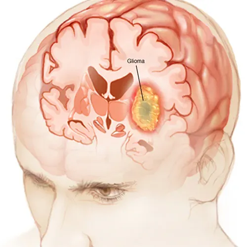 Brain Stem Glioma Treatment