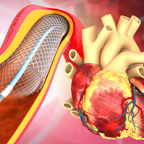 Cardiac Catheterization Treatment