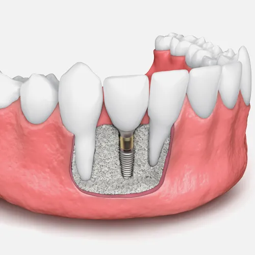 Dental Bone Grafting Surgery