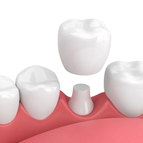 Dental Crown Treatment