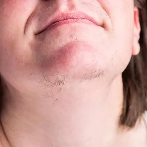 Hirsutism Treatment