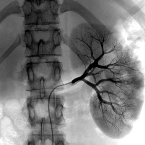 Renal Angiography