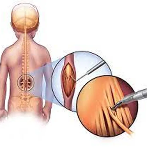 Selective Dorsal Rhizotomy Surgery