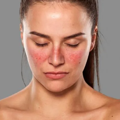 Systemic Lupus Erythematosus