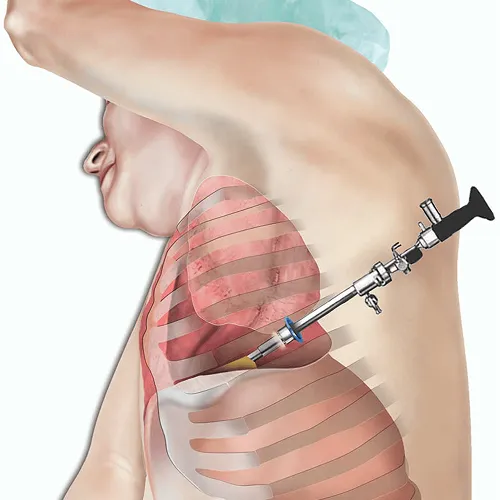 Thoracoscopy Surgery