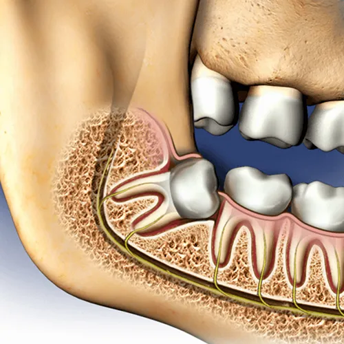 Wisdom Tooth Extraction Treatment