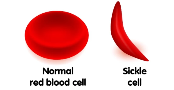 Malaria and Sickle Cell Anemia  The Wonder of Science