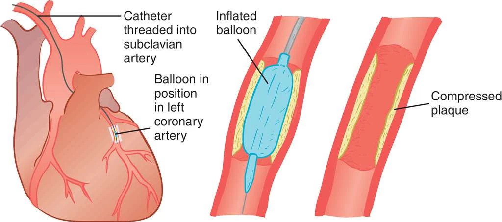 percutaneous transluminal coronary angioplasty (ptca)